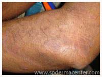 Psoriasis-OnTreatment